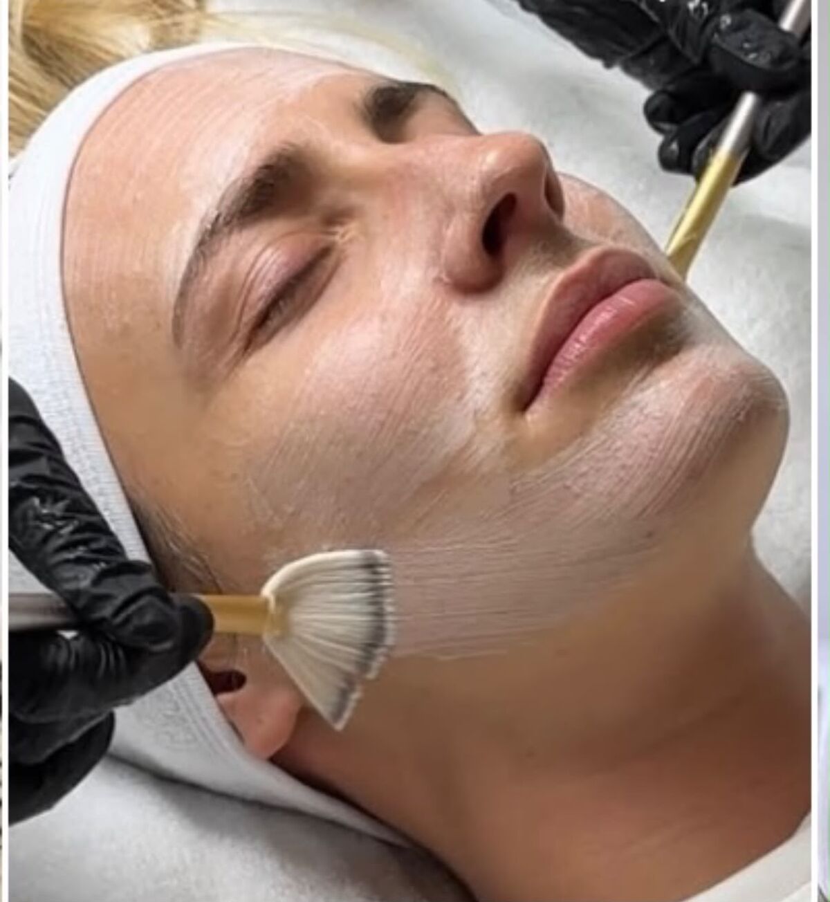 A chemical peel being brushed onto a client's face with a fan brush at Ombretta Clinic